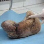 【驚愕】73歳の女性の子宮から30歳になる石化した胎児が発見！